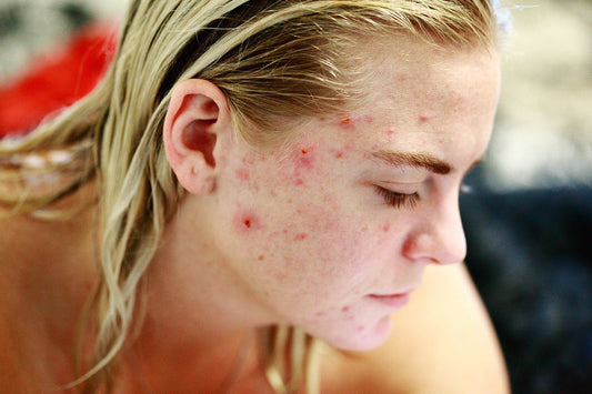 Why Are So Many of Us Dealing With Acne and Oily Skin?